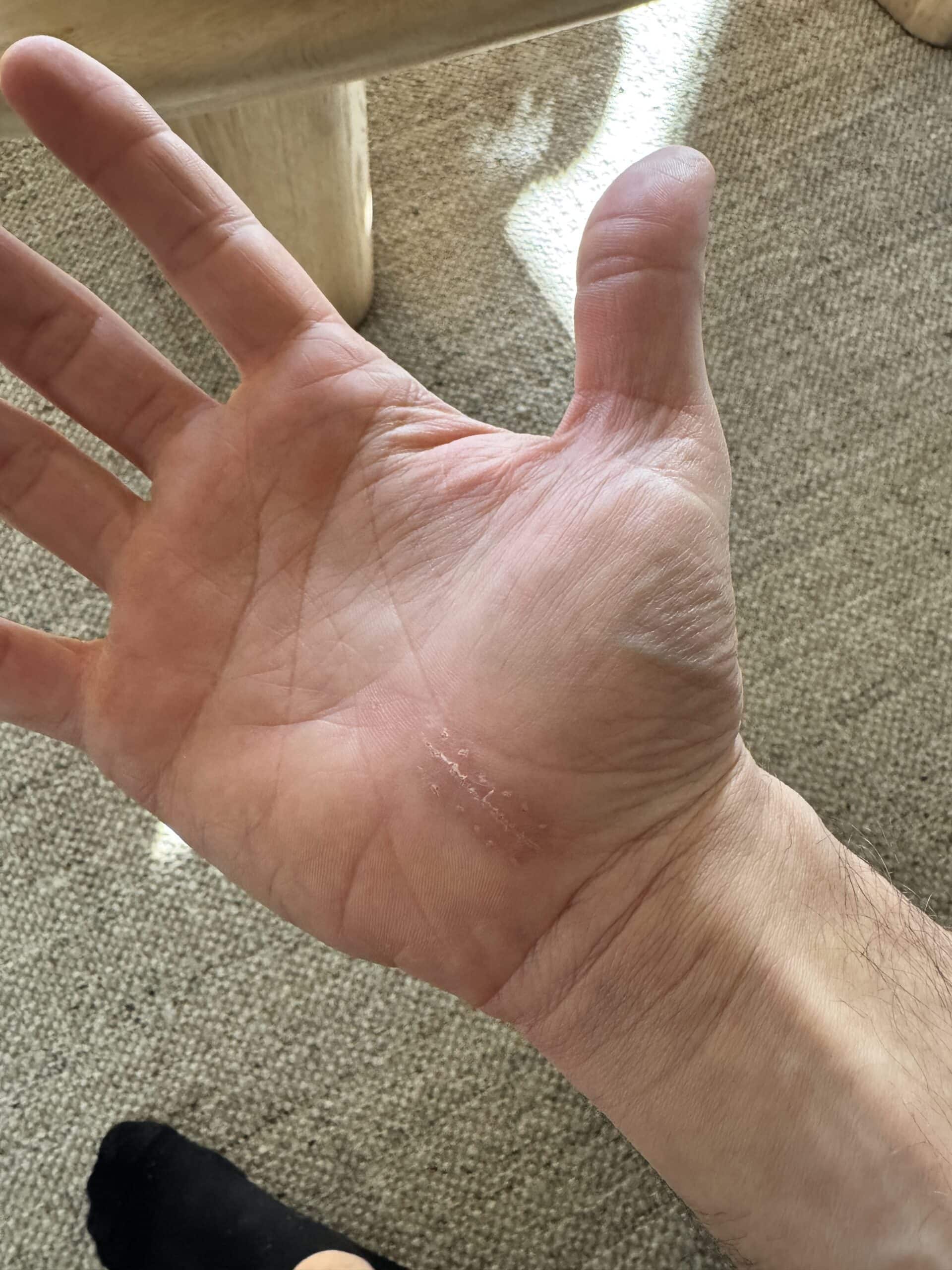 Kaleb Wyse holding his hand to show a scar from carpal tunnel surgery.